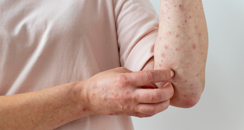 В Мордовии 14 июля обнаружена опасная вспышка кори