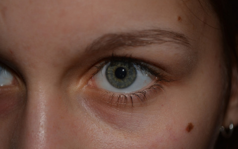 Врач назвал изменения родинок, которые могут стать причиной онкологии